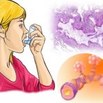 Asthma feature image (2)
